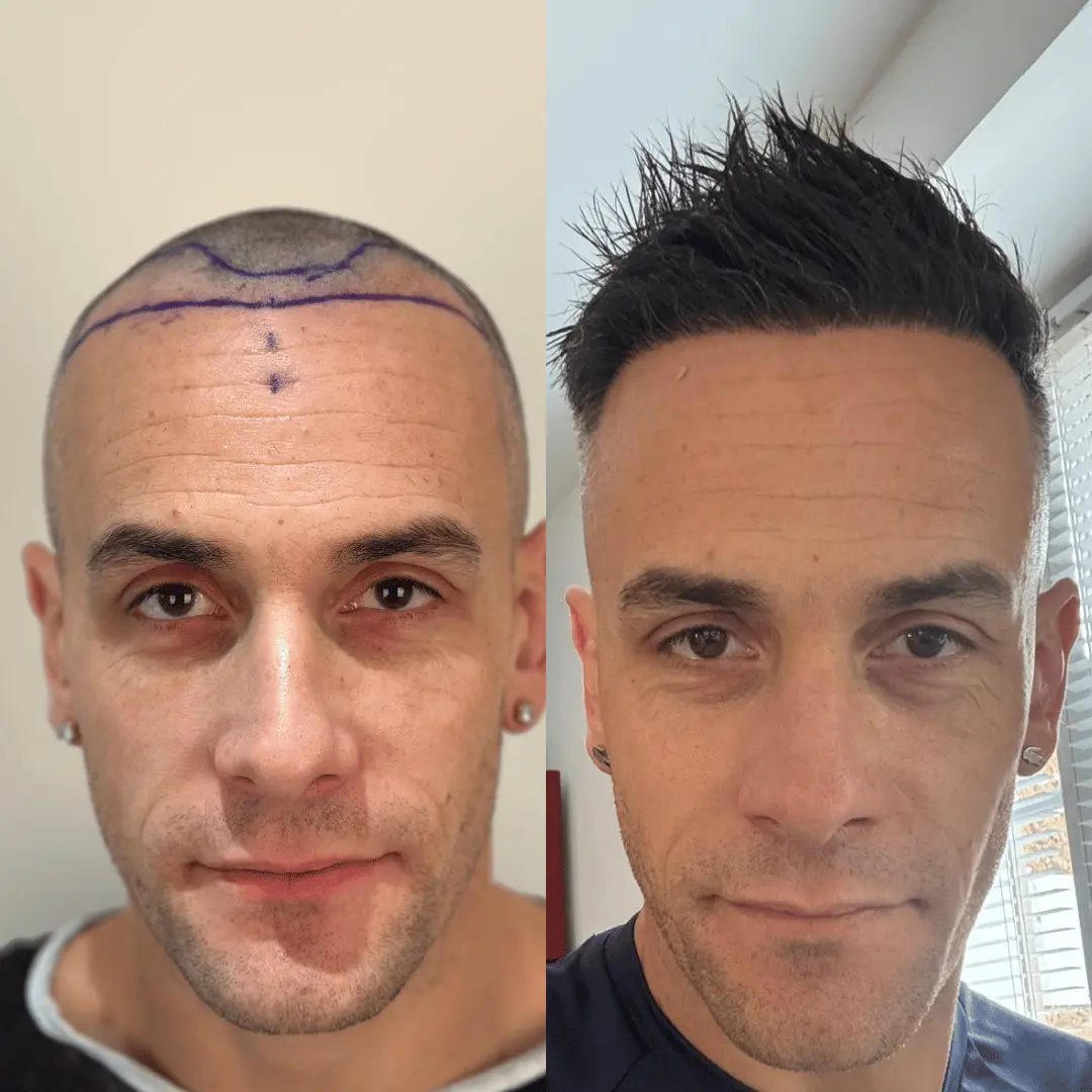 Man hair transplant before and after, Sapphire FUE, 2000 grafts, 9 Months