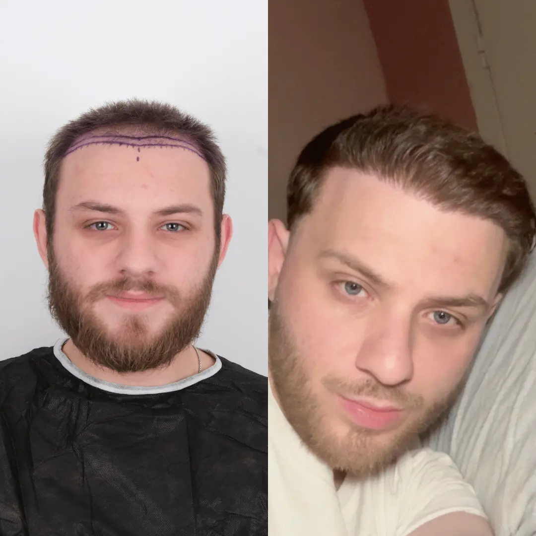 Man hair transplant before and after, Sapphire FUE, 2000 grafts, 10 Months