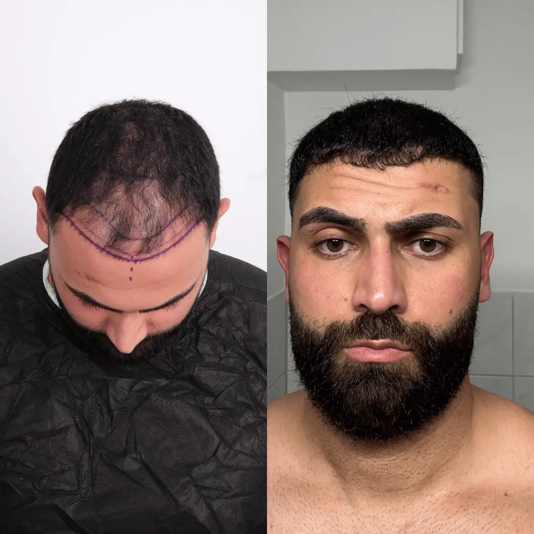 Man hair transplant before and after, Sapphire FUE, 2500 grafts, 11 Months