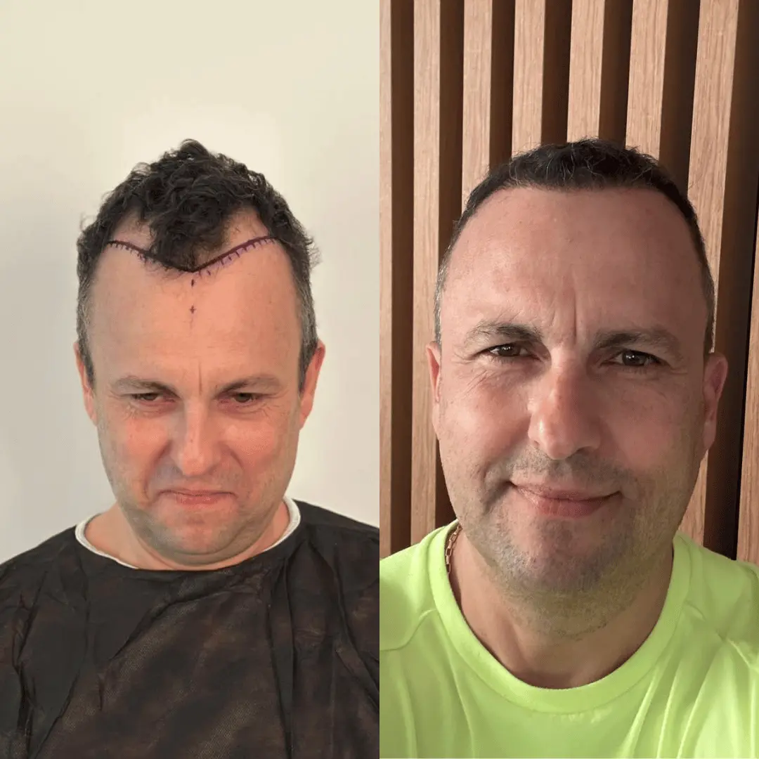 Man hair transplant before and after, DHI, 2500 grafts, 12 Months