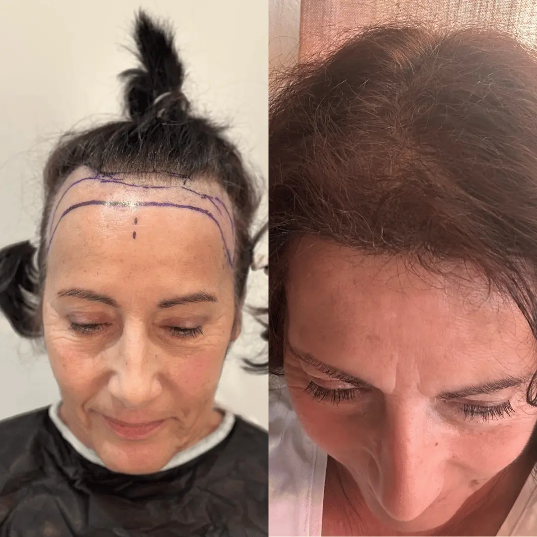 Woman hair transplant before and after, Sapphire FUE, 2500 grafts, 9 Months