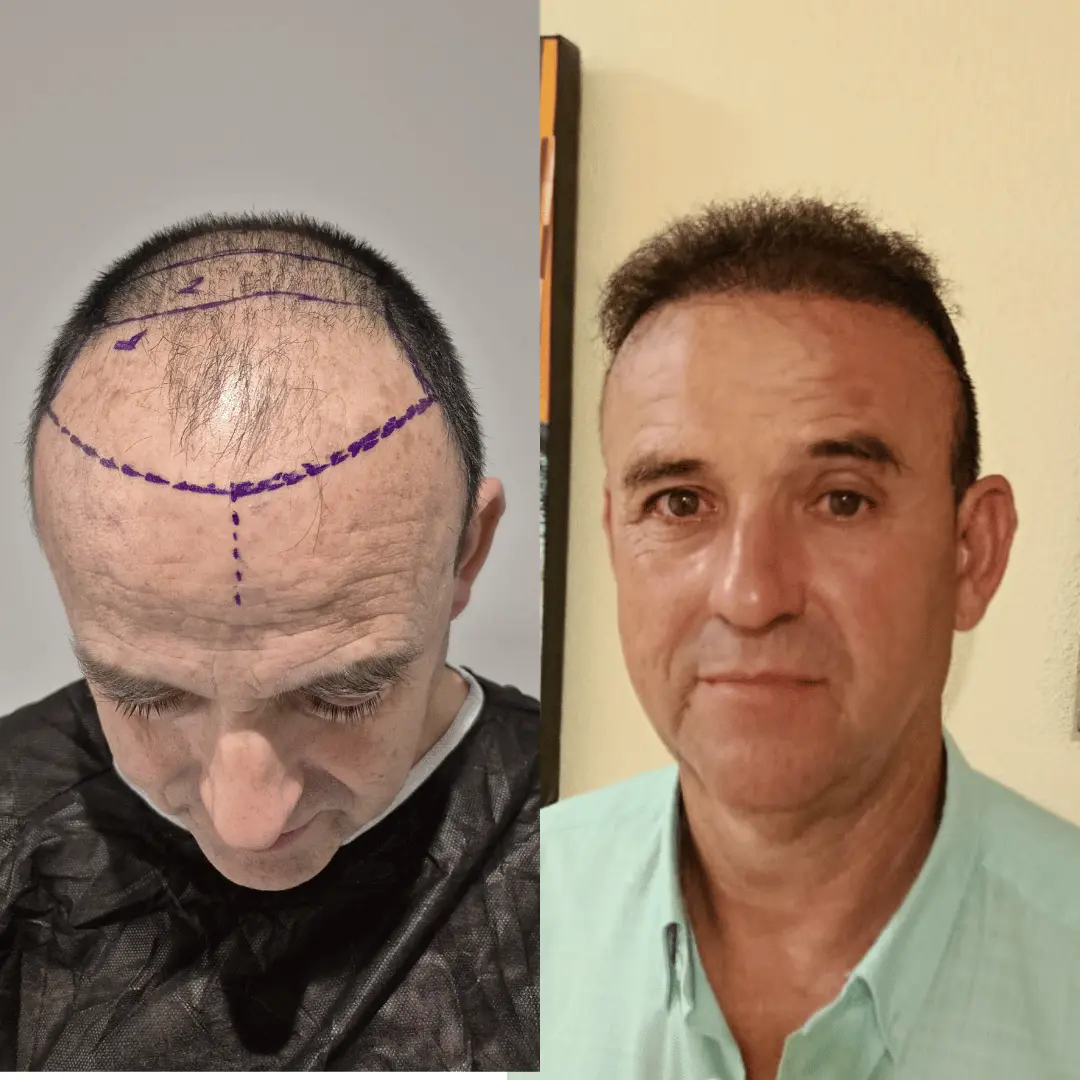 Man hair transplant before and after, Sapphire FUE, 3000 grafts, 10 Months