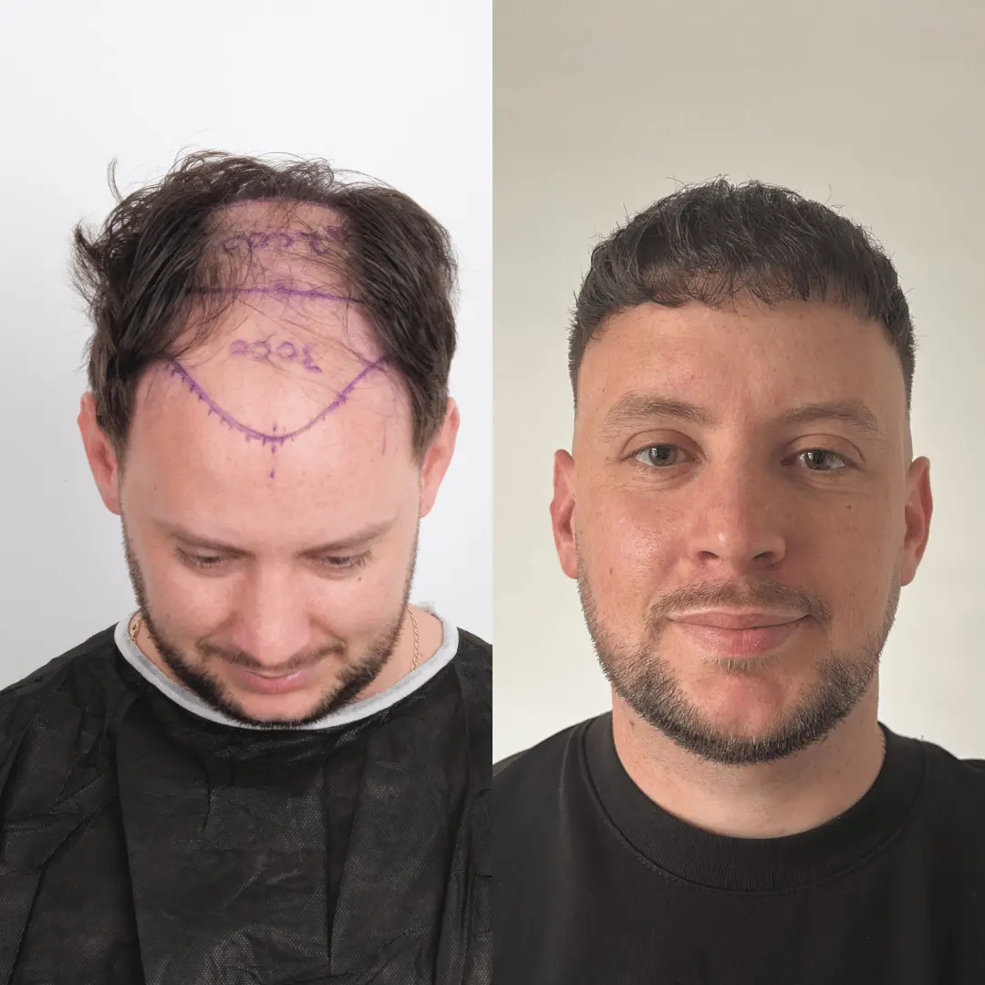 Man hair transplant before and after, Sapphire FUE, 3500 grafts, 11 Months