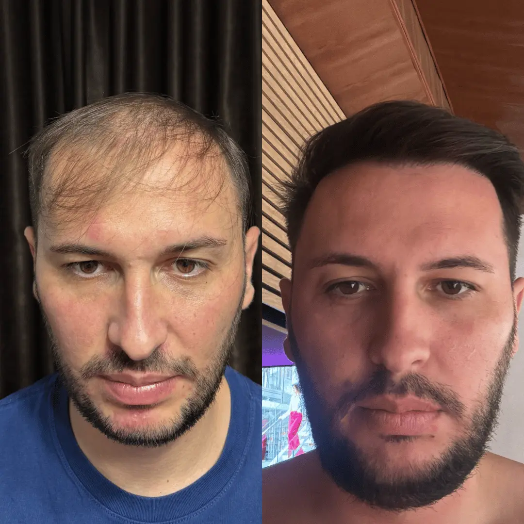 Man hair transplant before and after, Sapphire FUE, 3500 grafts, 12 Months