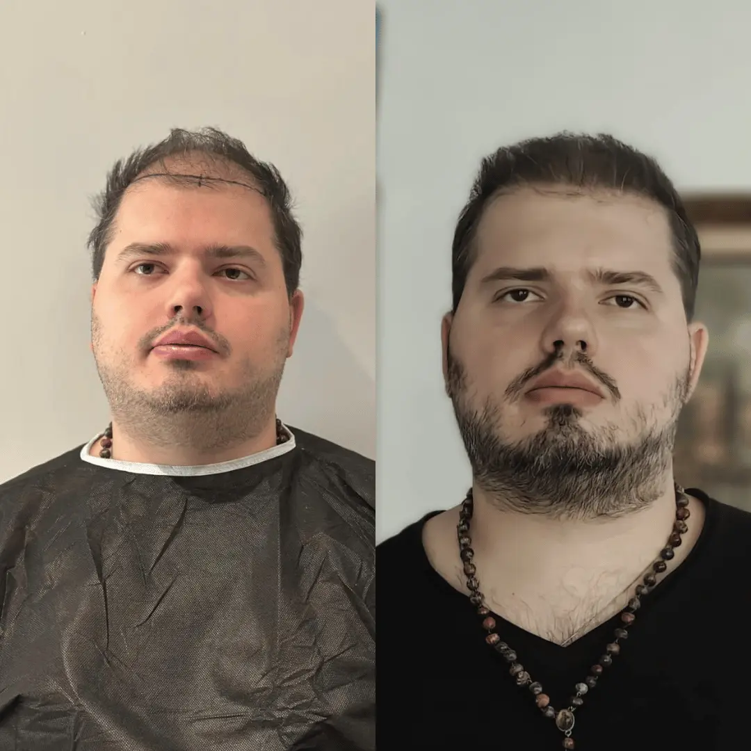 Man hair transplant before and after, Sapphire FUE, 3000 grafts, 9 Months