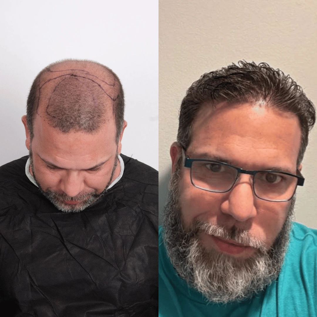 Man hair transplant before and after, Sapphire FUE, 3500 grafts, 10 Months