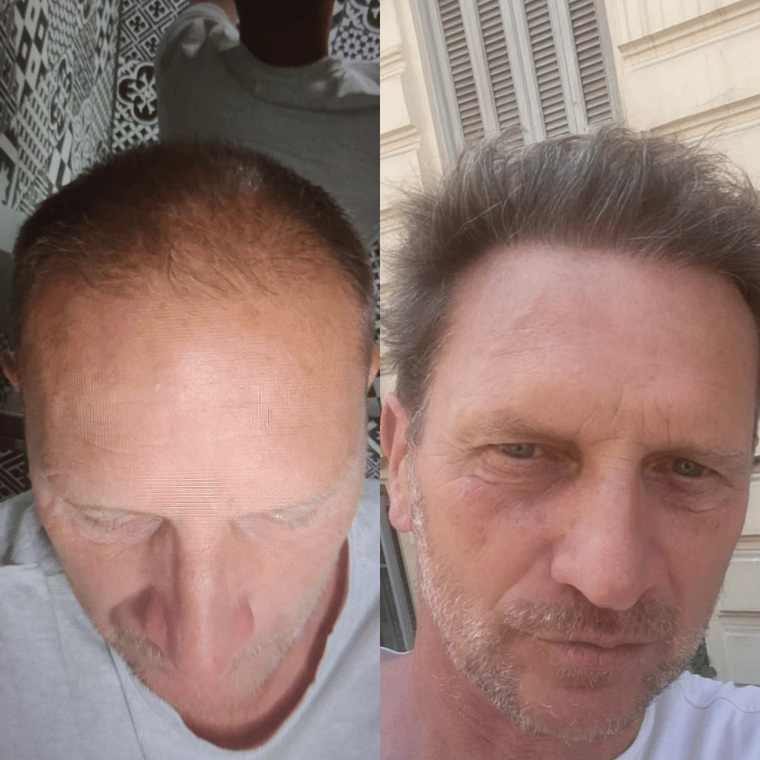 Man hair transplant before and after, DHI, 3500 grafts, 11 Months