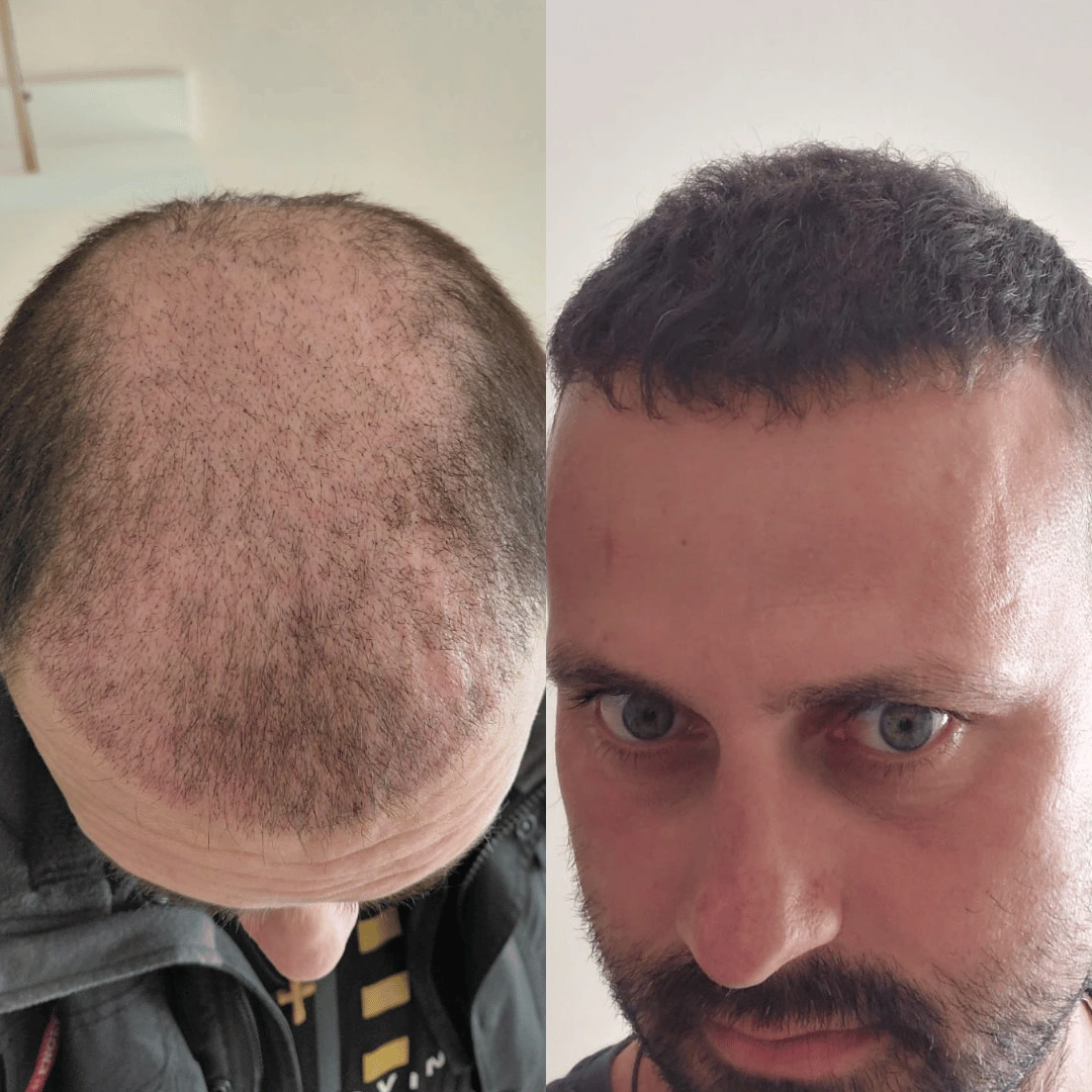Man hair transplant before and after, DHI, 4000 grafts, 12 Months