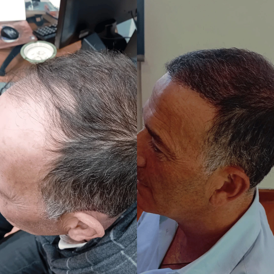 Man hair transplant before and after, Sapphire FUE, 4000 grafts, 9 Months