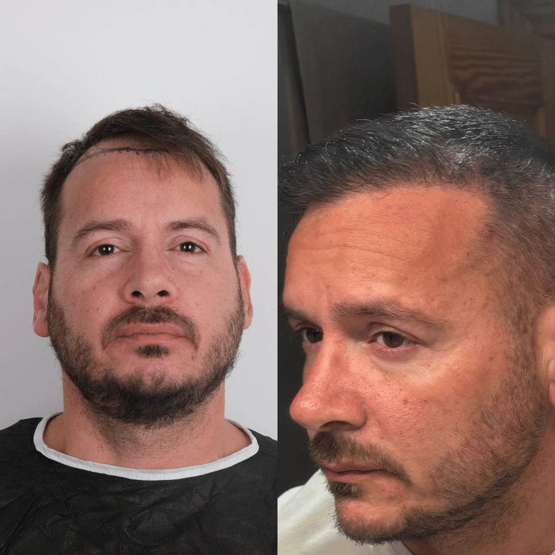 Man hair transplant before and after, Sapphire FUE, 2500 grafts, 10 Months