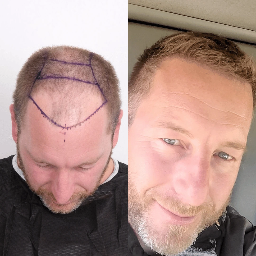 Man hair transplant before and after, Sapphire FUE, 4500 grafts, 11 Months