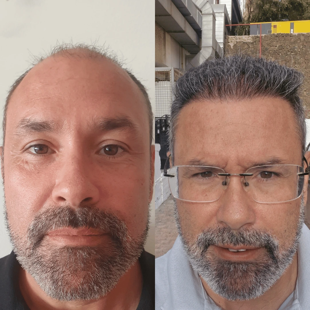 Man hair transplant before and after, DHI, 4500 grafts, 12 Months