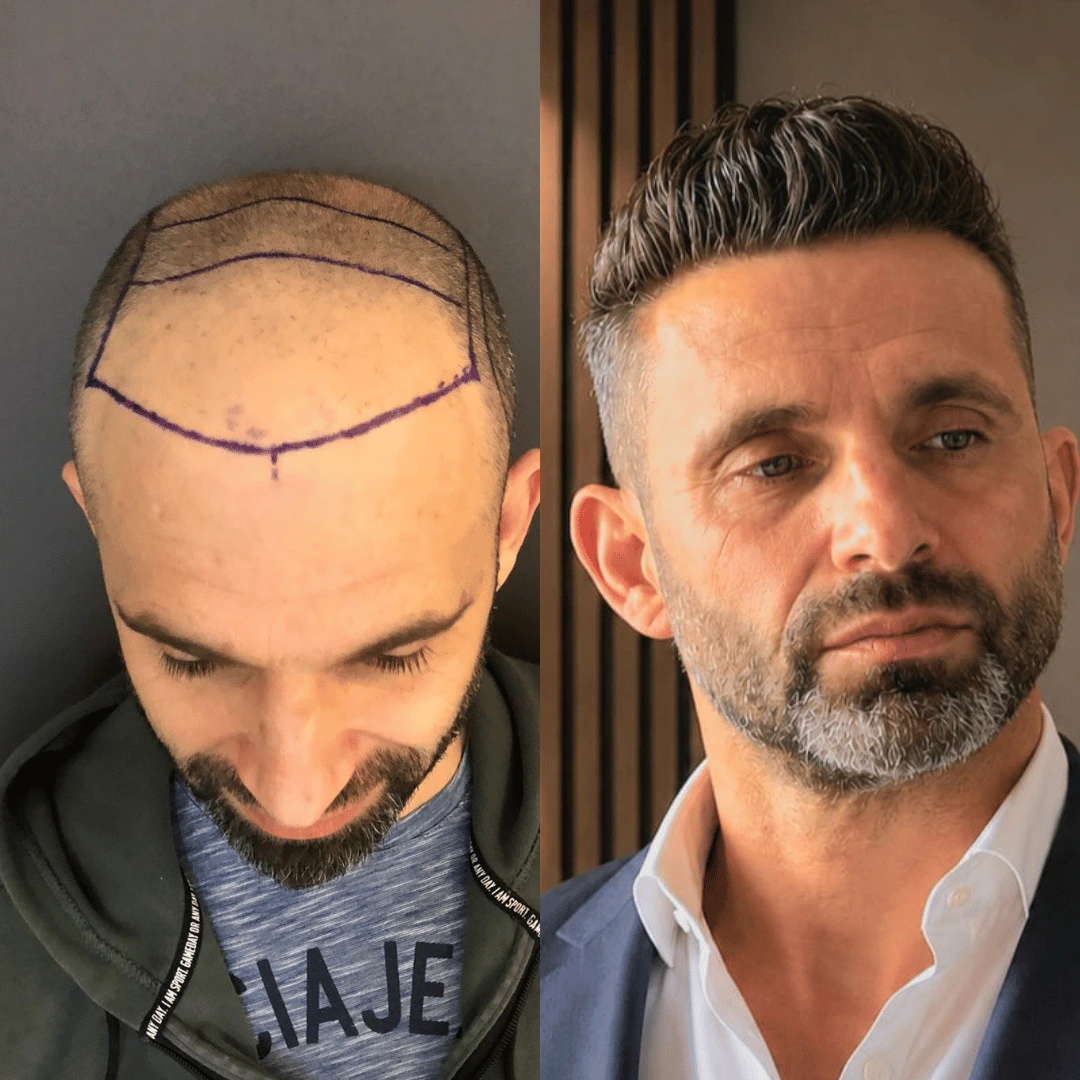 Man hair transplant before and after, Sapphire FUE, 5000 grafts, 9 Months