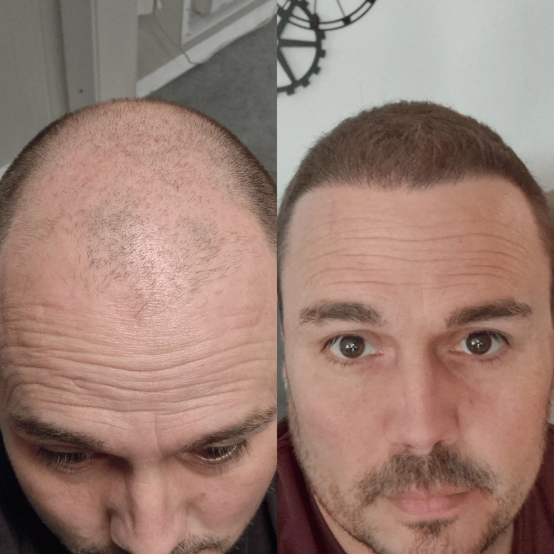 Man hair transplant before and after, Sapphire FUE, 5000 grafts, 10 Months
