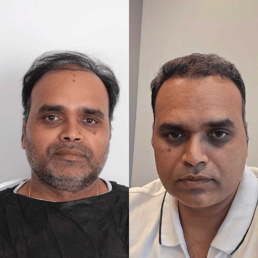 Man hair transplant before and after, Sapphire FUE, 5000 grafts, 11 Months