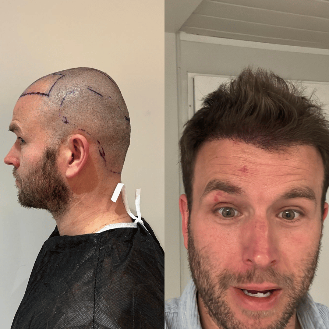 Man hair transplant before and after, Sapphire FUE, 2000 grafts, 12 Months