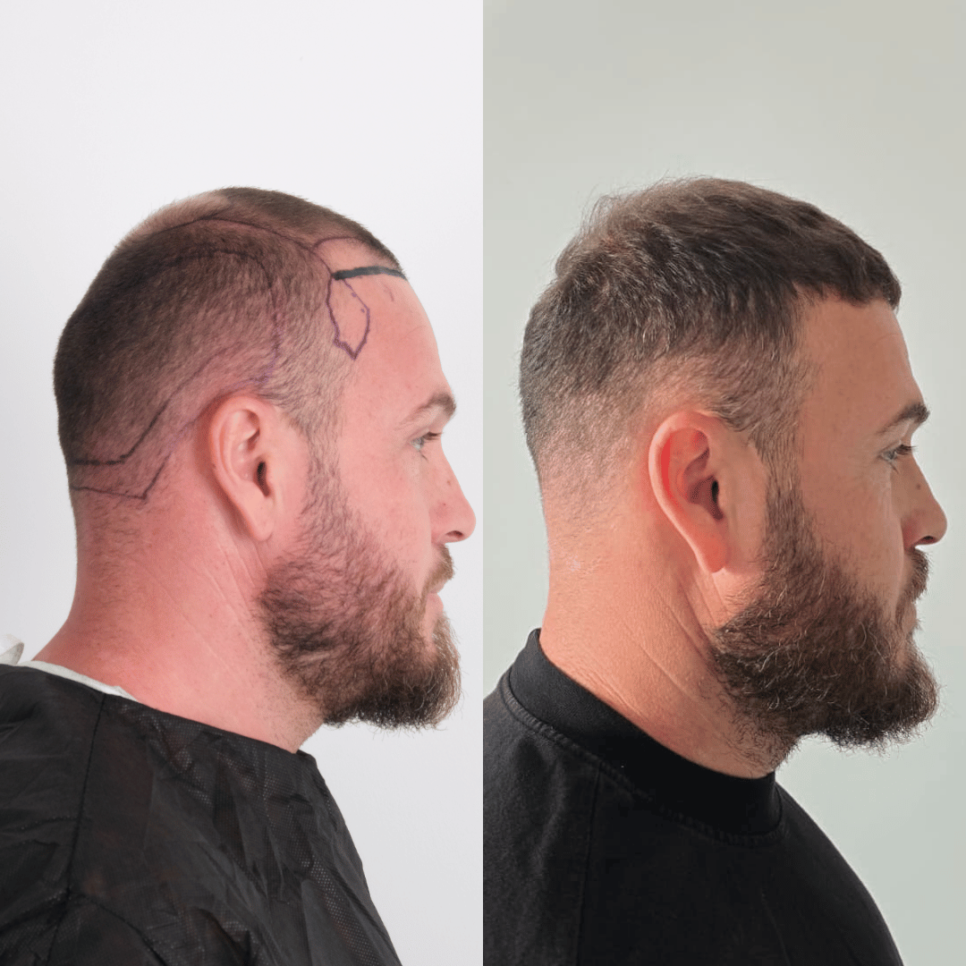 Man hair transplant before and after, DHI, 3000 grafts, 9 Months