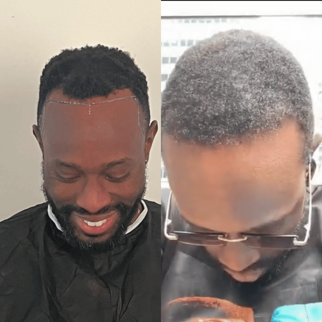 Man hair transplant before and after, Sapphire FUE, 3000 grafts, 10 Months