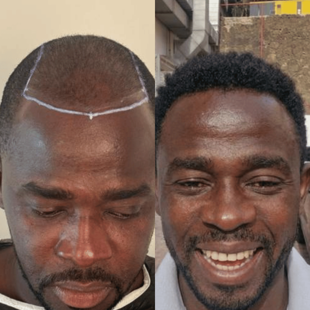 Man hair transplant before and after, Sapphire FUE, 3000 grafts, 11 Months
