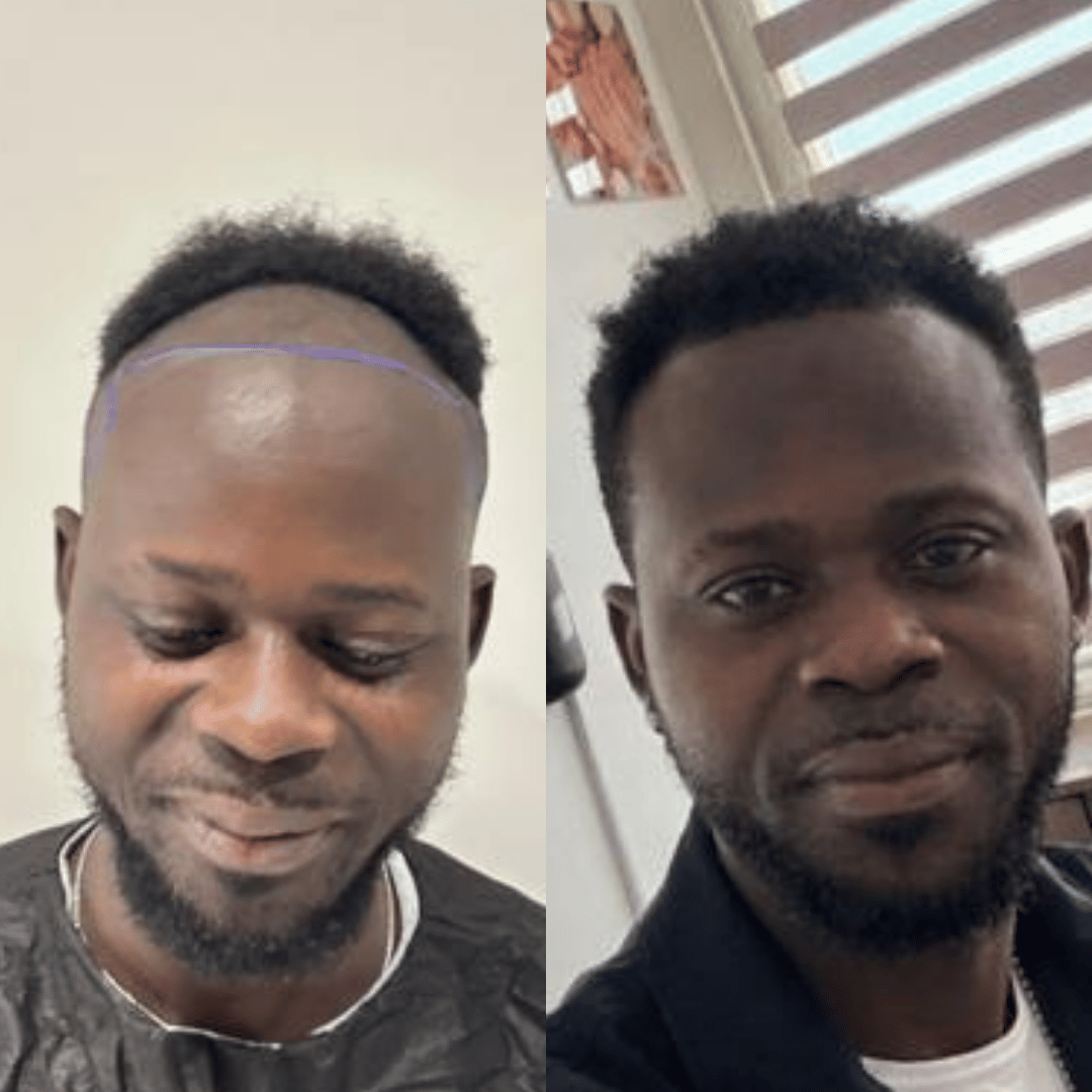 Man hair transplant before and after, Sapphire FUE, 3500 grafts, 12 Months