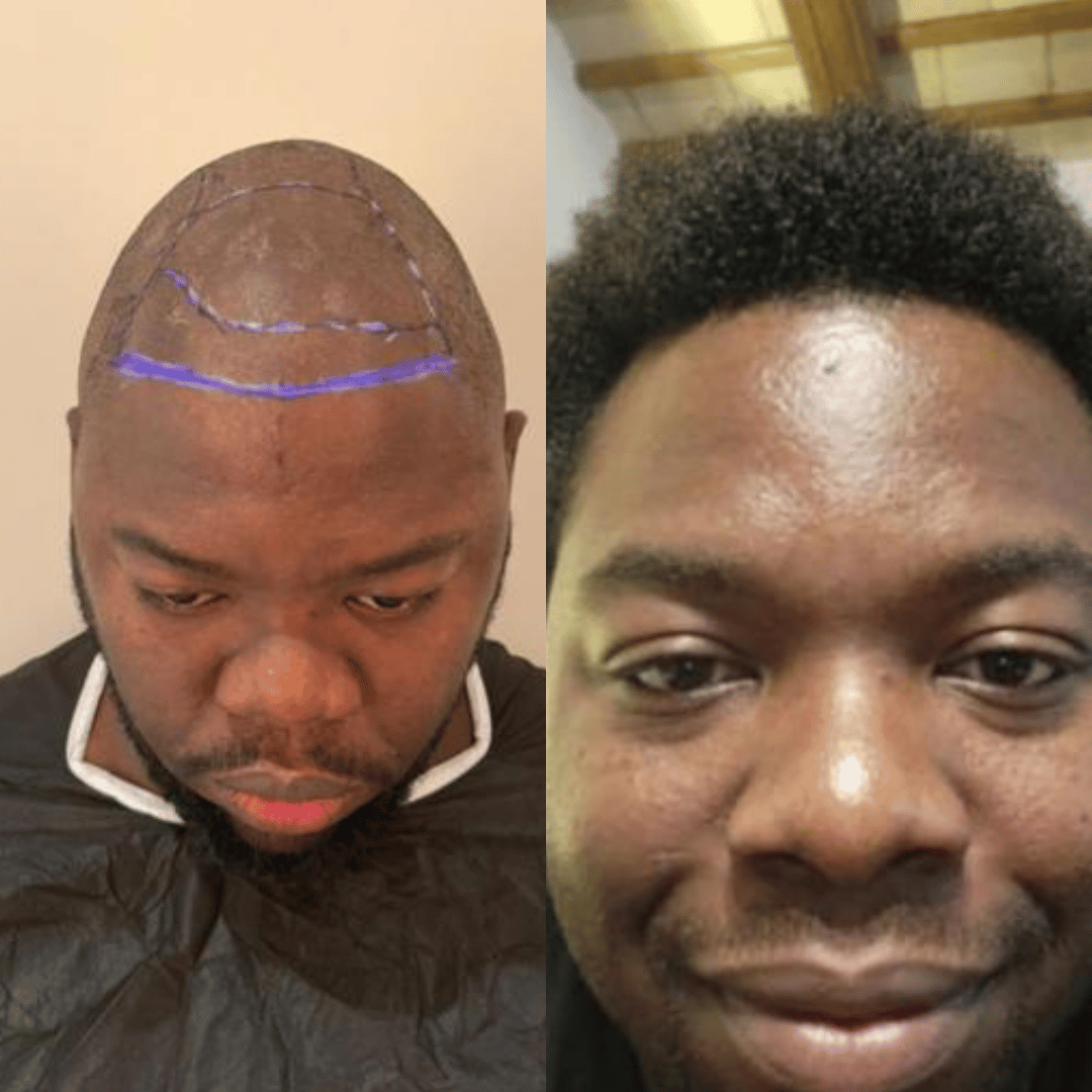 Man hair transplant before and after, Sapphire FUE, 4000 grafts, 9 Months