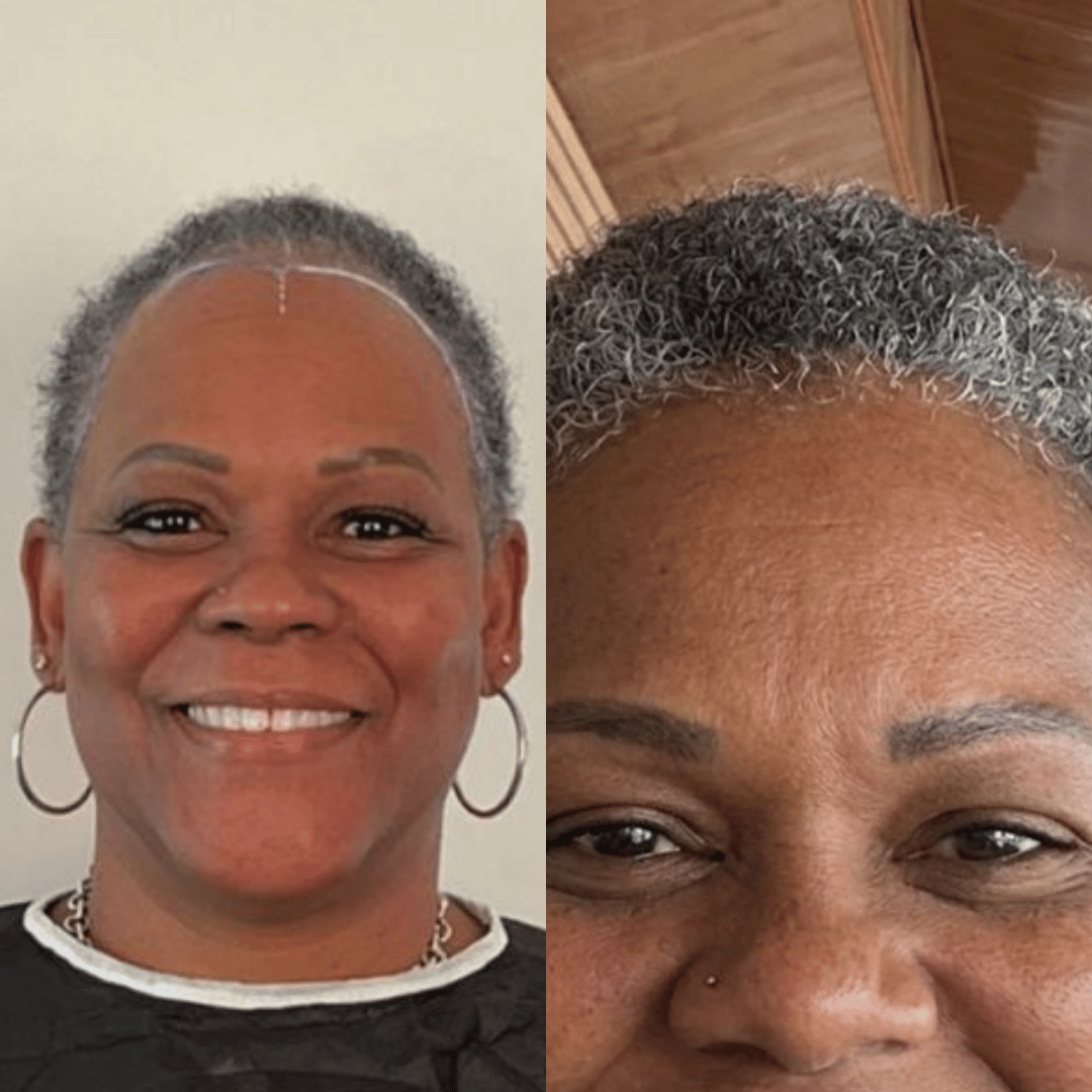 Woman hair transplant before and after, Sapphire FUE, 3000 grafts, 10 Months