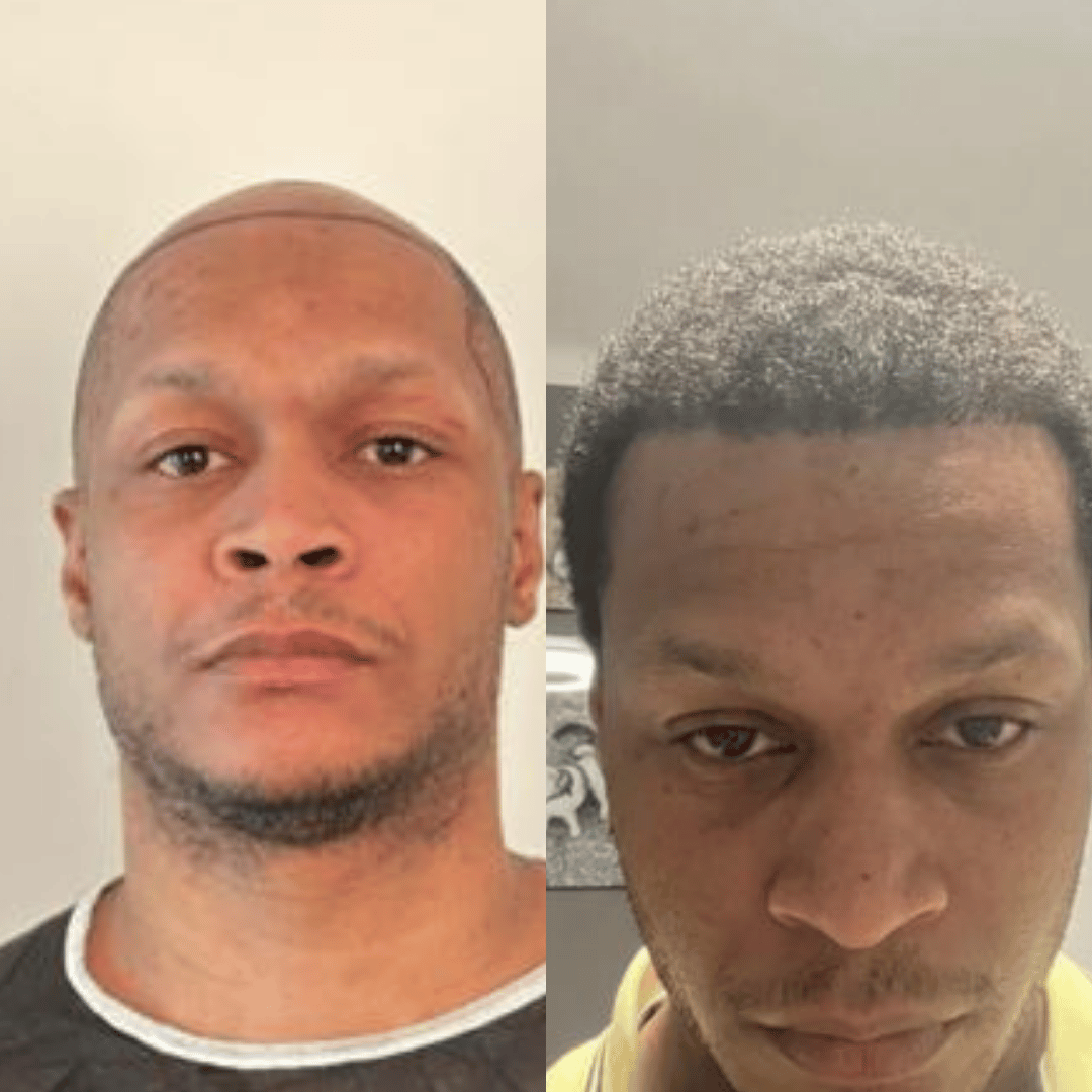 Man hair transplant before and after, Sapphire FUE, 3500 grafts, 11 Months