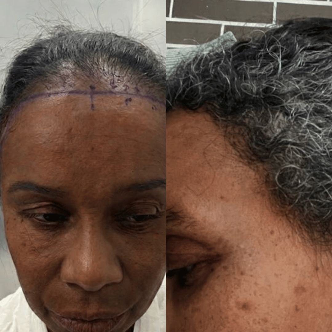 Woman hair transplant before and after, Sapphire FUE, 3500 grafts, 12 Months