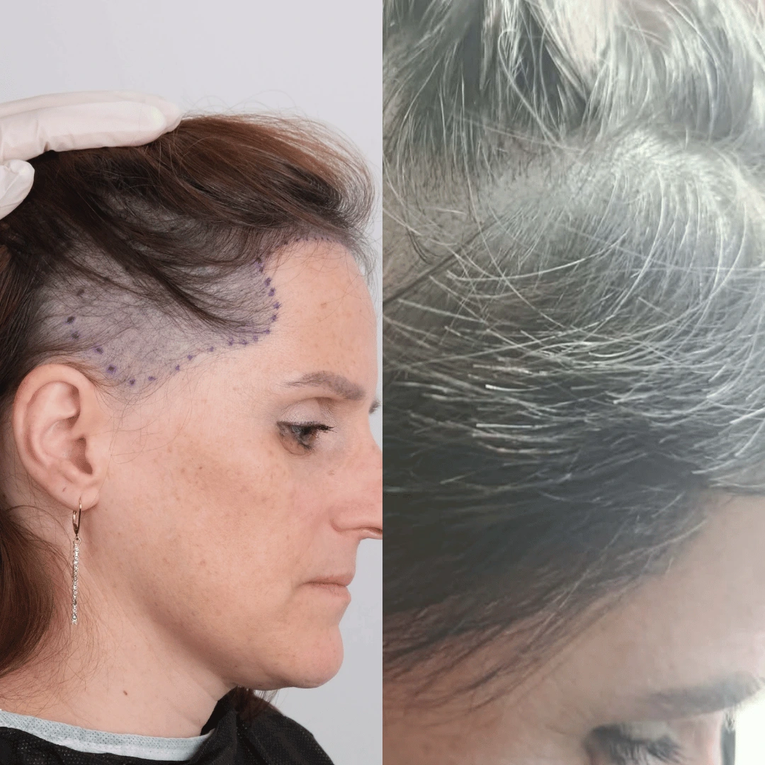 Woman hair transplant before and after, Sapphire FUE, 3500 grafts, 9 Months
