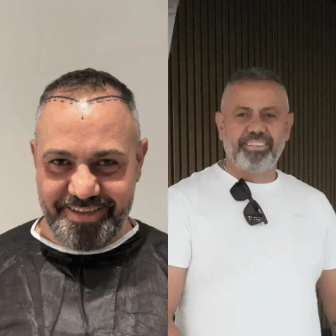 Man hair transplant before and after, Sapphire FUE, 2500 grafts, 10 Months