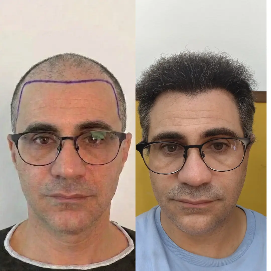 Man hair transplant before and after, Sapphire FUE, 5500 grafts, Norwood 6, 10 Months
