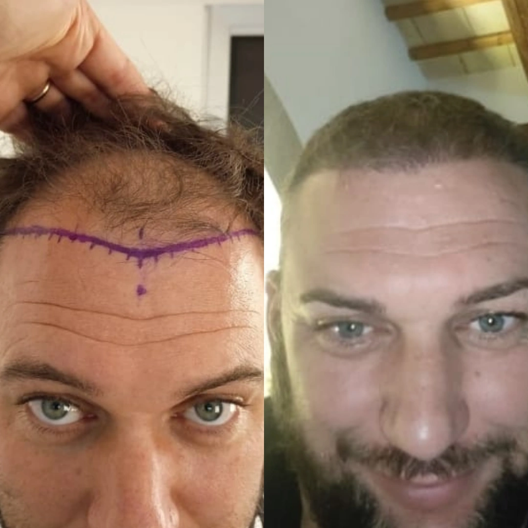 Man hair transplant before and after, Sapphire FUE, 5500 grafts, Norwood 6, 6 Months