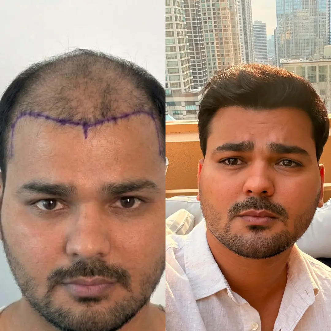 Man hair transplant before and after, Sapphire FUE, 6000 grafts, Norwood 6, 10 Months