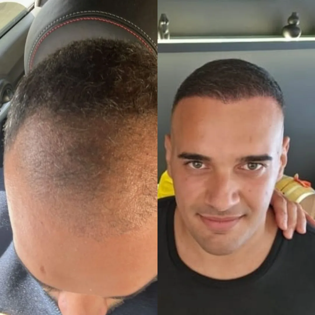 Man hair transplant before and after, Sapphire FUE, 6000 grafts, Norwood 6