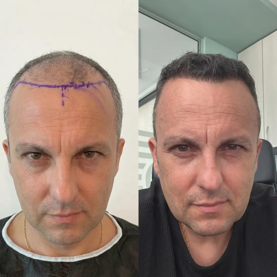 Man hair transplant before and after, Sapphire FUE, 6500 grafts, Norwood 6, 12 Months