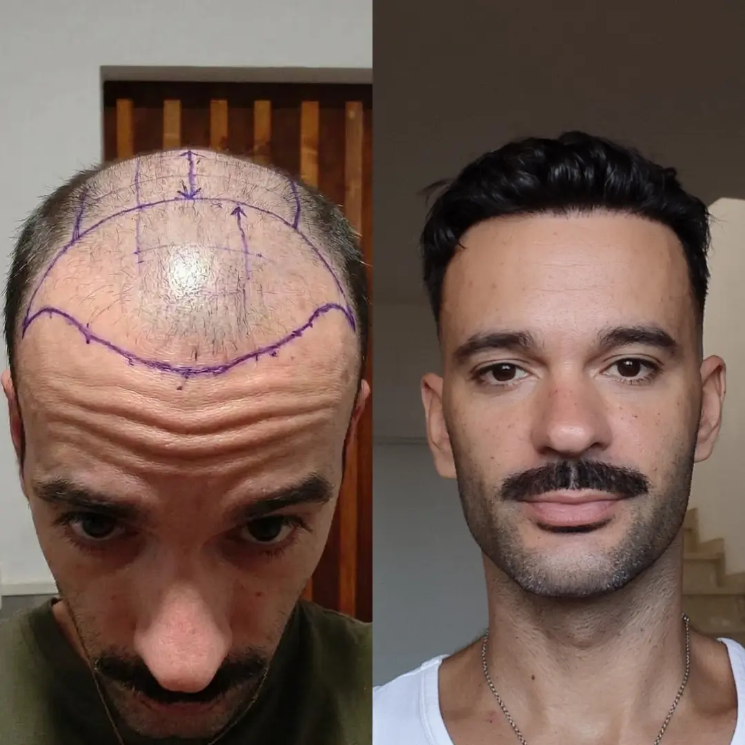Man hair transplant before and after, Sapphire FUE, 6500 grafts, Norwood 6, 12 Months