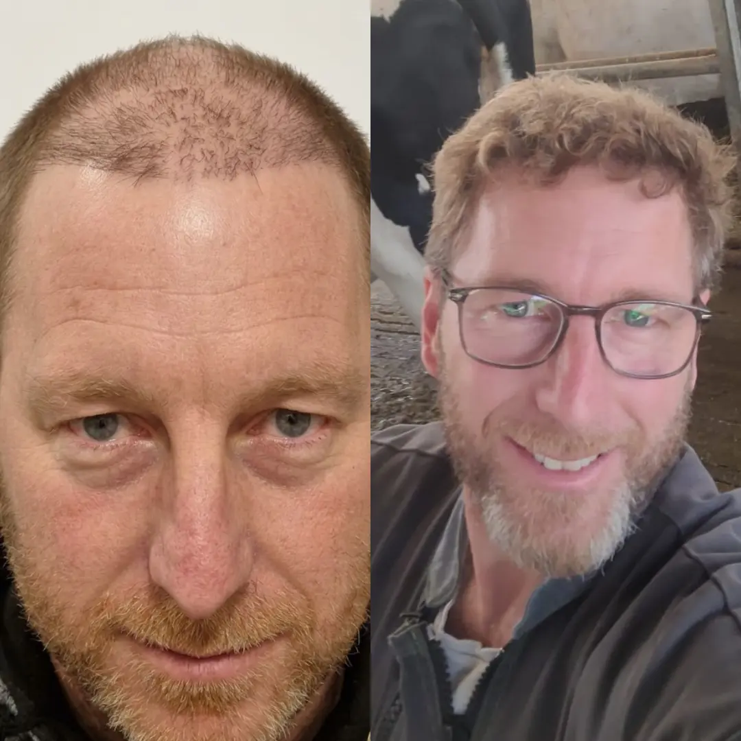 Man hair transplant before and after, Sapphire FUE, 7000 grafts, Norwood 6, 8 Months