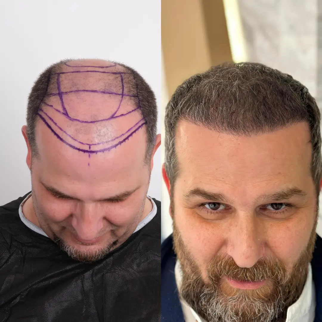 Man hair transplant before and after, Sapphire FUE, 7500 grafts, Norwood 6, 6 Months