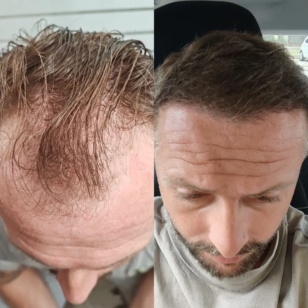 Man hair transplant before and after, Sapphire FUE, 7500 grafts, Norwood 6, 10 Months