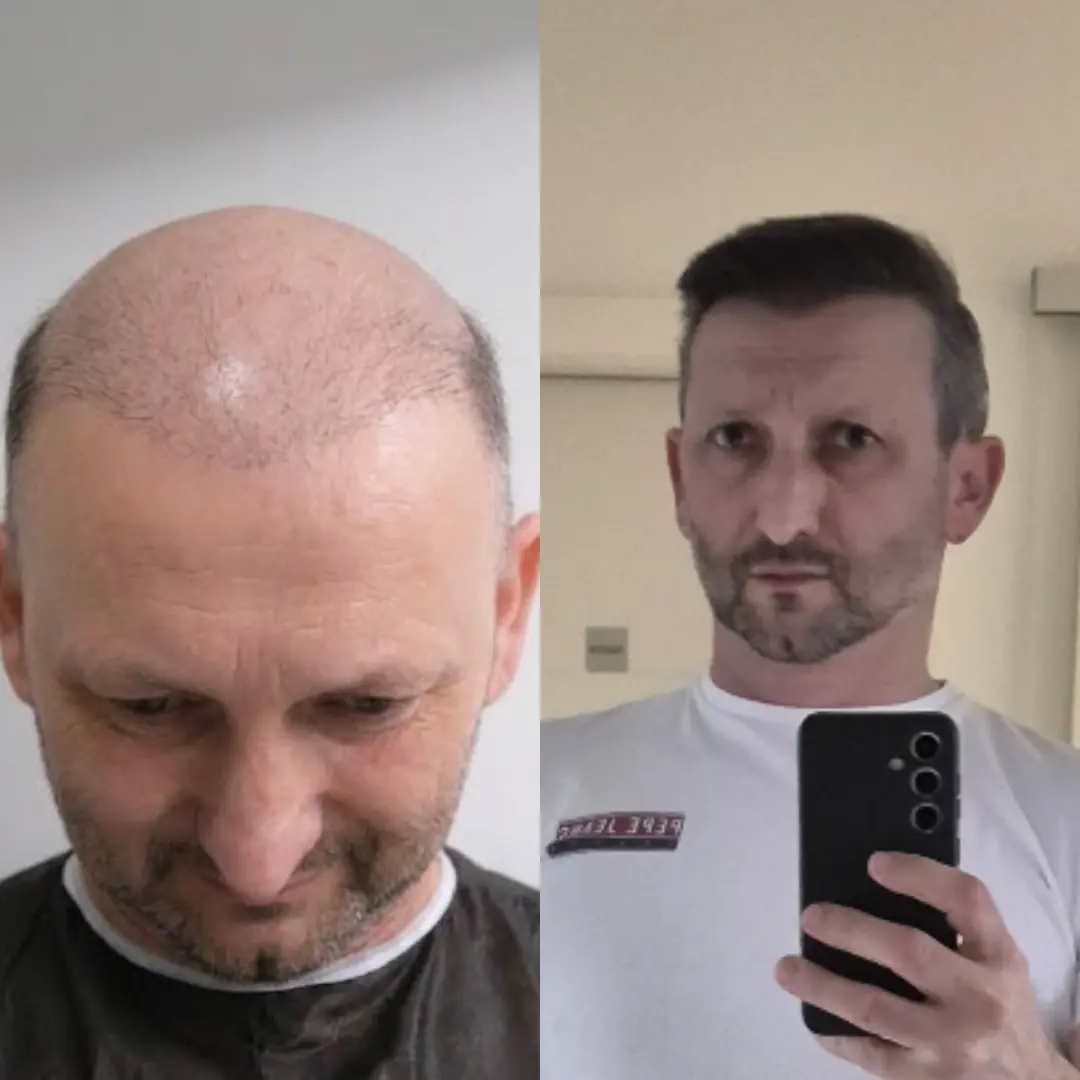 Man hair transplant before and after, Sapphire FUE, 8000 grafts, Norwood 6, 10 Months