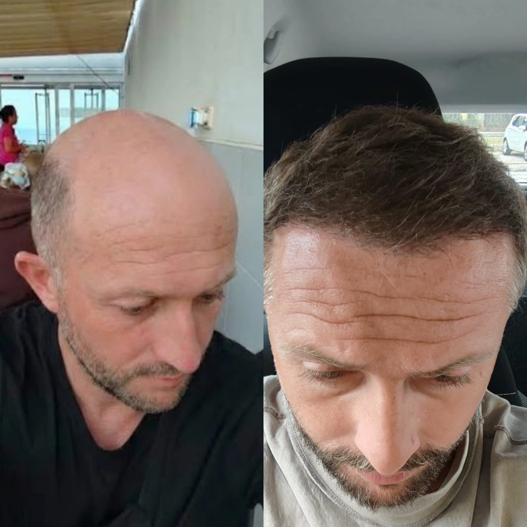 Norwood 7 hair transplant before and after at Istanbul Vita, Sapphire FUE, 8,000 grafts, 12 months after surgery