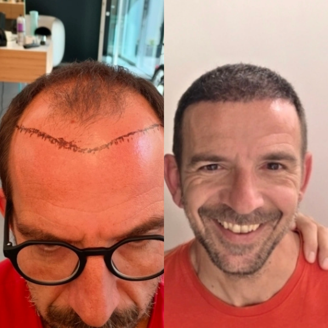 Man hair transplant before and after, Sapphire FUE, 6000 grafts, Norwood 6, 12 Months