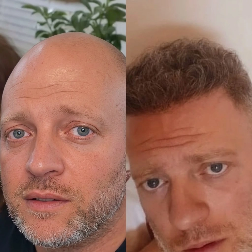 Norwood 7 hair transplant before and after at Istanbul Vita, Sapphire FUE, 8,000 grafts, 12 months after surgery