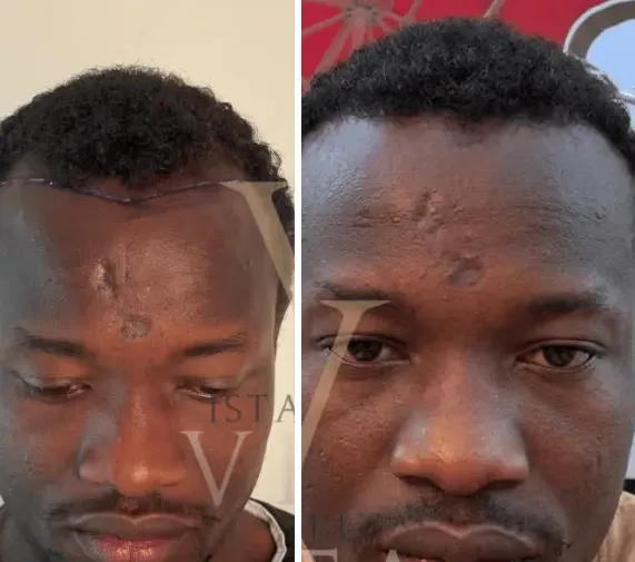 Afro hair transplant Case A: before and after at Istanbul Vita