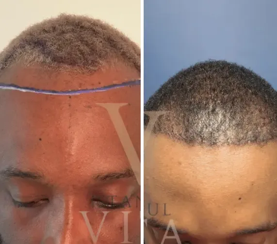 Afro hair transplant Case B: before and after at Istanbul Vita