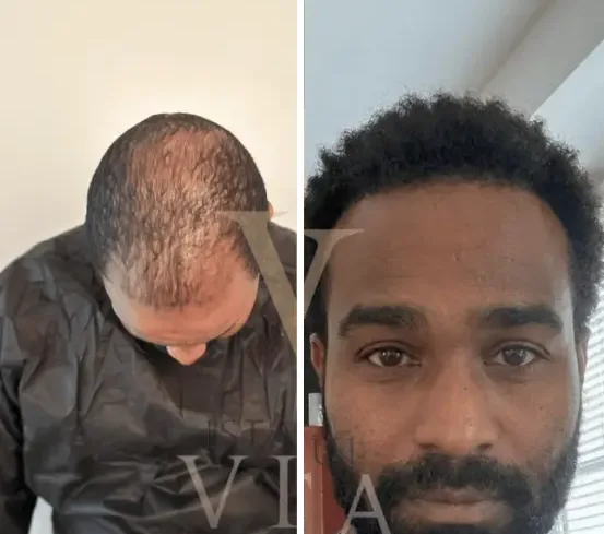 Afro hair transplant Case C: before and after at Istanbul Vita