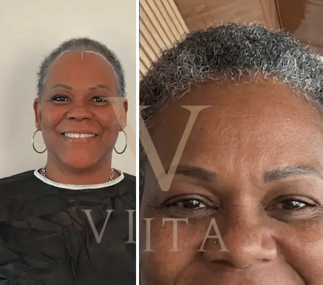 Afro hair transplant Case D: before and after at Istanbul Vita