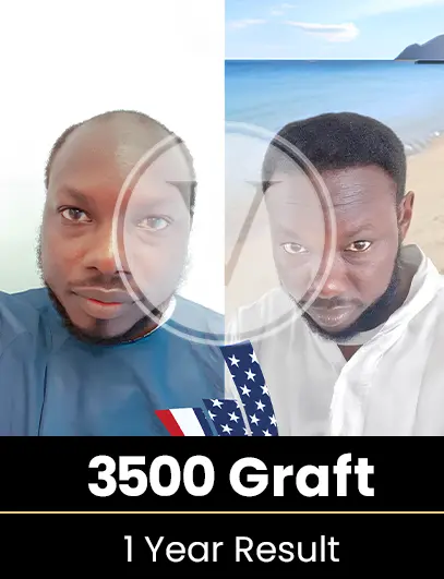 5300 Graft Hair Transplant Result after 1 year