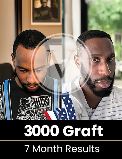 4800 Graft Hair Transplant Result after 9 months