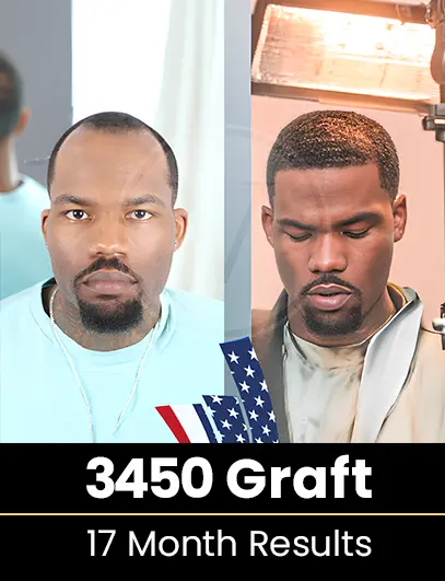 5200 Graft Hair Transplant Result after 1 year